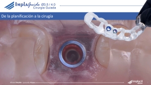 ImplaGuide – Cirugía Guiada